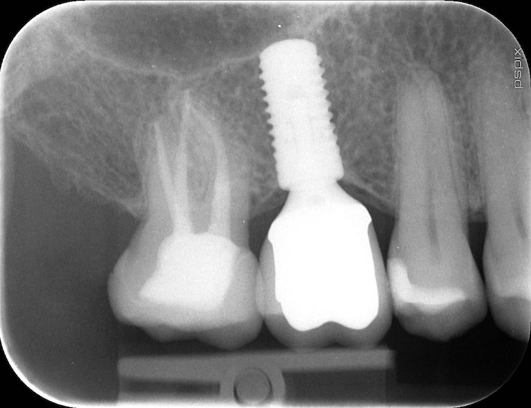 Dental Implants