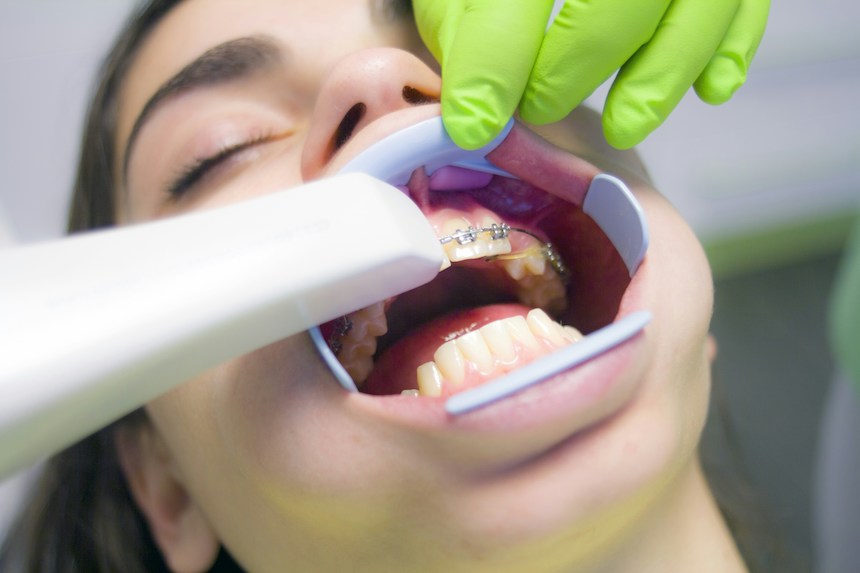 Teeth Straightening